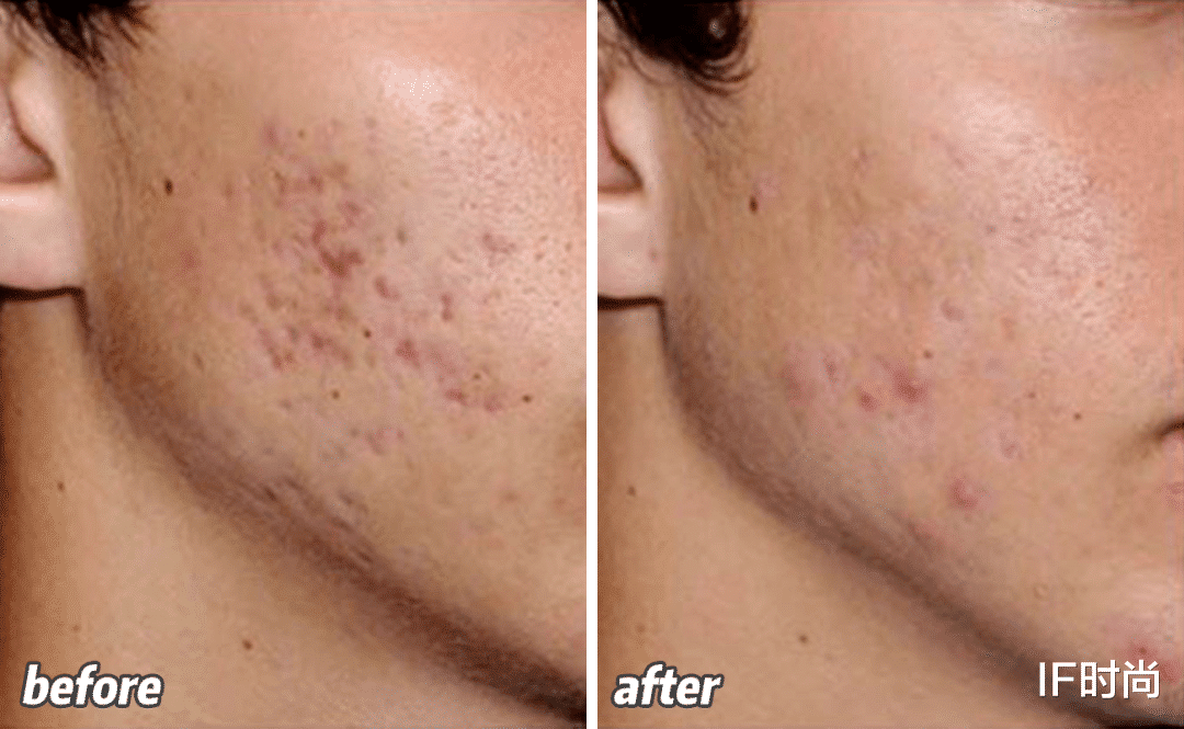 IF时尚|奥运选手也“换头”？快看这篇医美科普