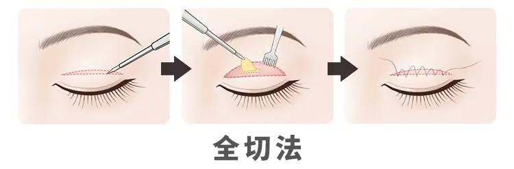 小美说美|割的双眼皮怎么才能看不出来