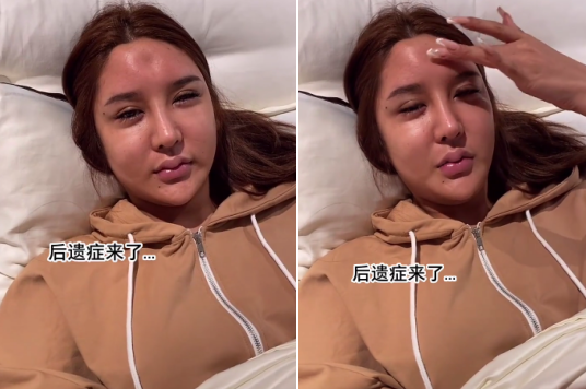 整容|23岁女网红晒整容失败图！脑门凹陷一块太吓人，五官怪异眼睛抽搐