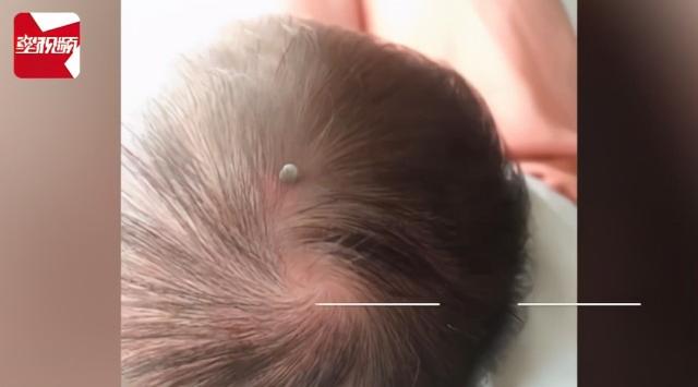 蜱虫 惊险！出生仅4天婴儿被蜱虫咬伤，父亲：发现时头全部吸进去了