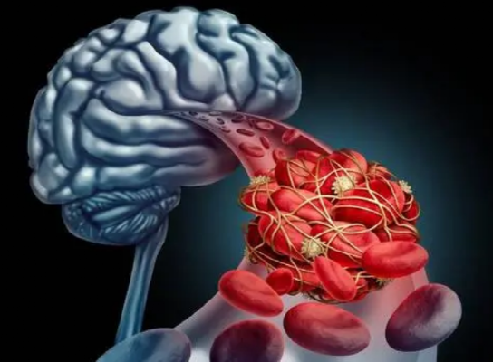 脑梗|脑梗来临，脚先知，提醒：脚部若有3种特征，可能血管已堵死