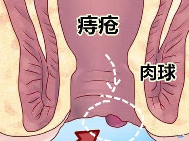 养生小盛|怎么消除痔疮肉球？肛肠专家揭秘痔疮最佳痔疮方法，百万患者受益！