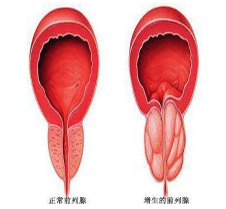 中医李嘉医生|这几种原因是导致男性前列腺肥大的主要原因