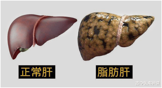 古今医案研读|无论男女，身体出现3种“异常”，肝脏多半已“肿如馒头”尽快检查