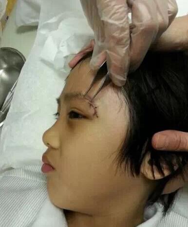 费曼|真被毁容了？12岁费曼眼角疤痕明显，视力受永久性伤害，这波亏了