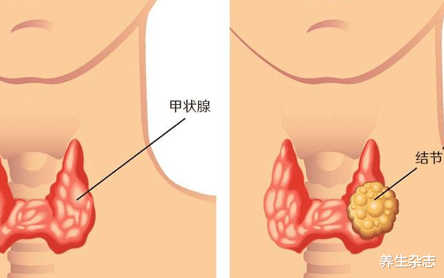 医生|外卖小哥浑身瘙痒，2个月后查出甲状腺结节，医生：身体2处发痒，尽早排查
