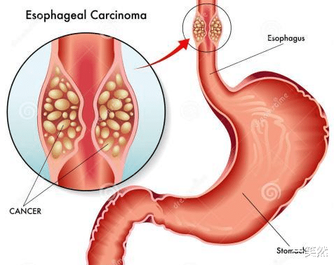 一笑然|别再把食管癌当咽炎!记住这几点可以知道如何避免食道癌
