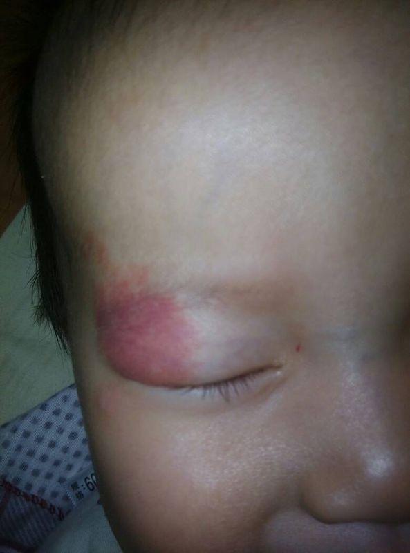 西红柿妈妈|为何有些新生儿会有“胎记”？可能跟孕妇的习惯有关，要管住自己