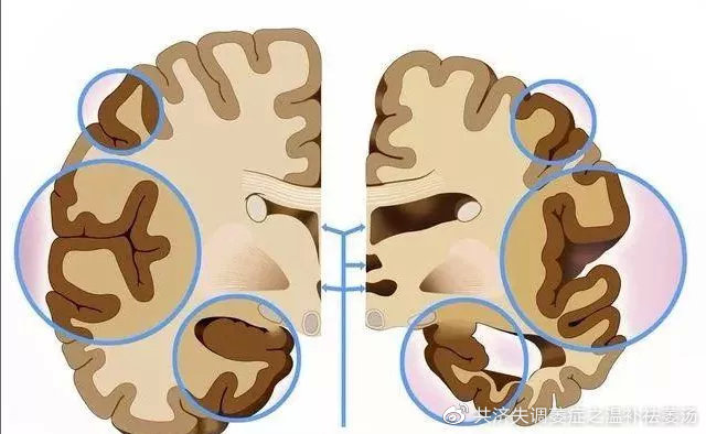 四季健康 小脑萎缩的治疗要根据患者情况而定