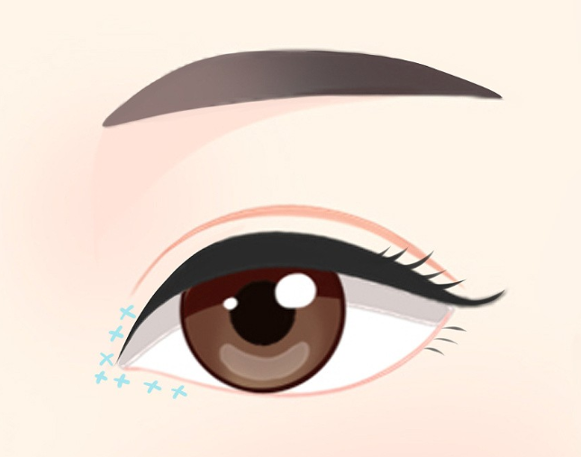 史迎军眼整形|史迎军眼整形 | 开眼角容易留疤、回缩吗？眼角到底该不该开？