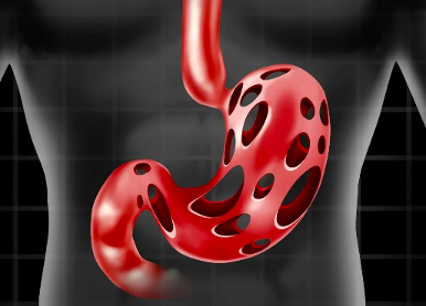 天天听健康 母女二人双双确诊胃癌，医生直言：2样东西吃太多，很容易惹癌上身