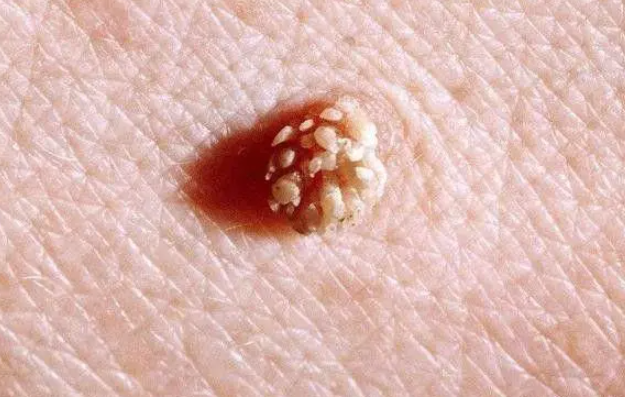 千金芳|26岁女子私处长“菜花”，别不当回事，医生：多半是HPV捣的鬼！