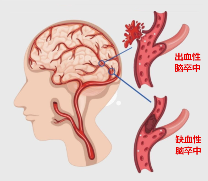 脑中风 中科西部干细胞研究院：中风干细胞新疗法！