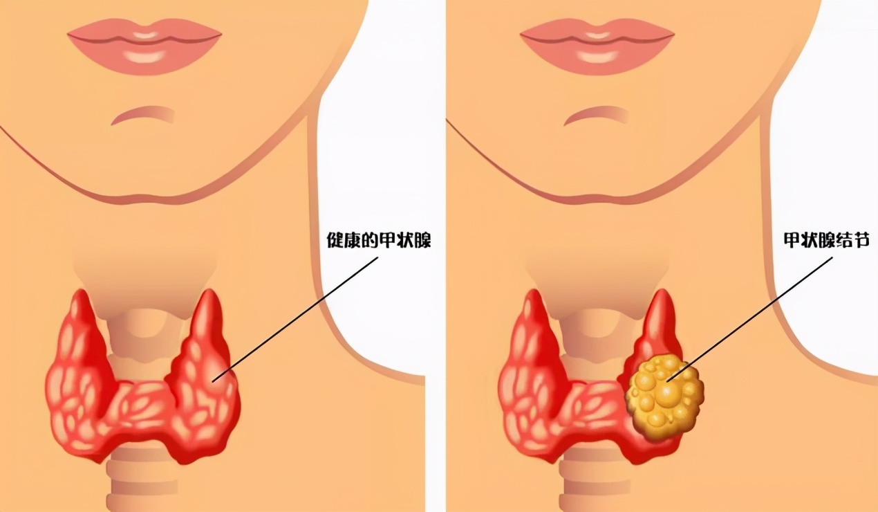 甲状腺癌|14岁女孩“喉结”突出，确诊甲状腺癌，医生直言：3个习惯尽早改正