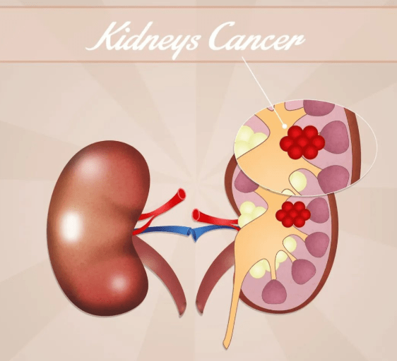 蔬菜|加速肾病到尿毒症的4大误区,别不当回事儿,等肾衰竭就晚了