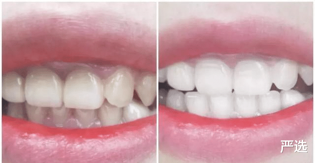 严选 牙黄口臭不用愁,刷牙时放点家家都有的小物,牙齿亮白口气清新
