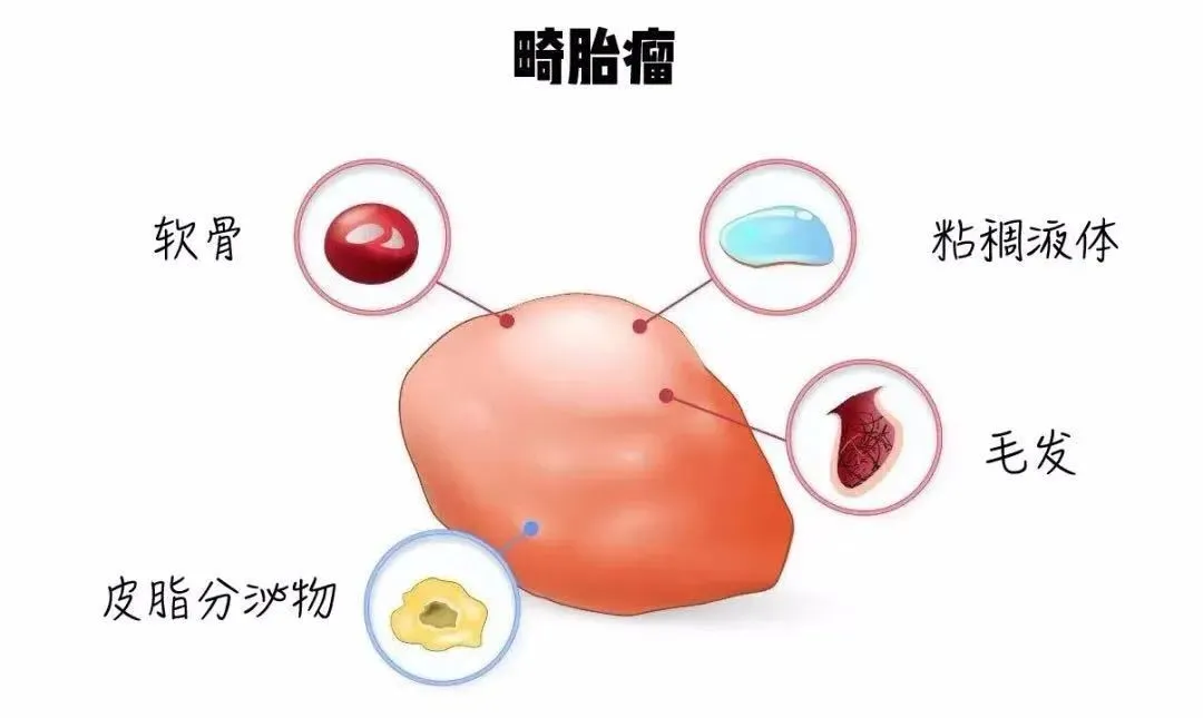 四川大众健康网|成都男子“怀胎”45年,医生“剖腹产”出5斤重“胎儿”