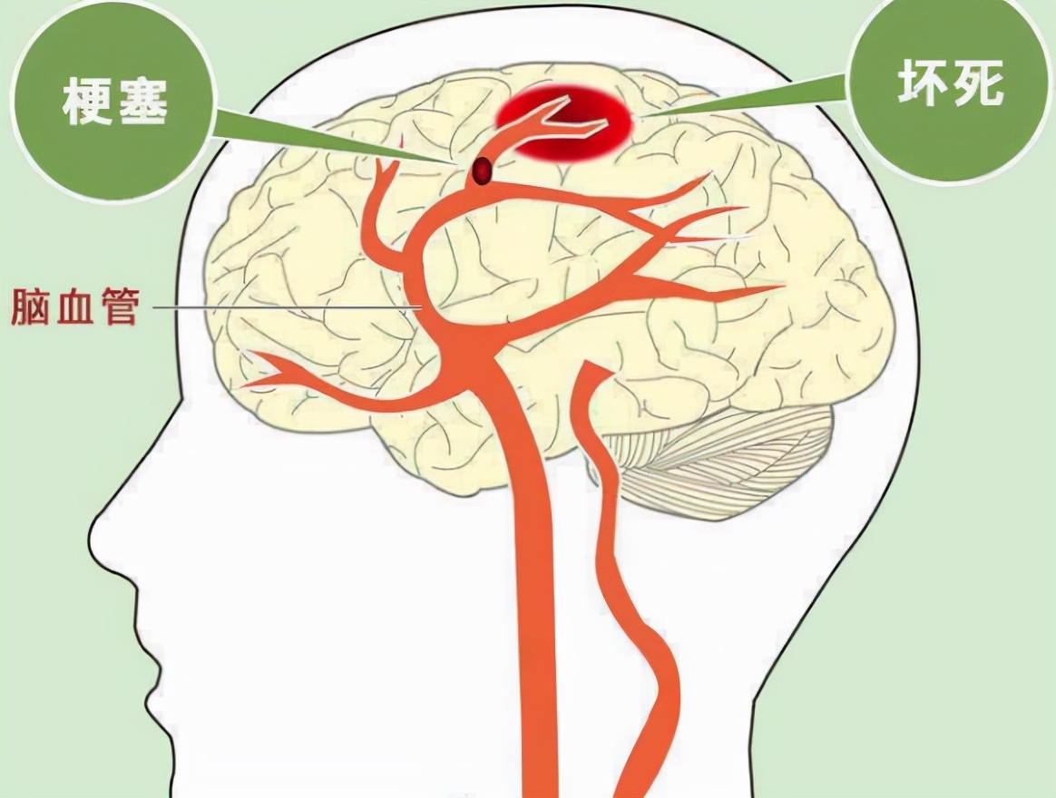 脑梗|脑梗“救命恩人”被找到,没事随便吃一点,血管不堵塞,脑梗不来扰