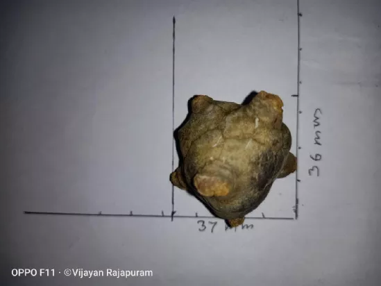 膀胱结石|你永远都不知道，结石会从哪个部位长出来