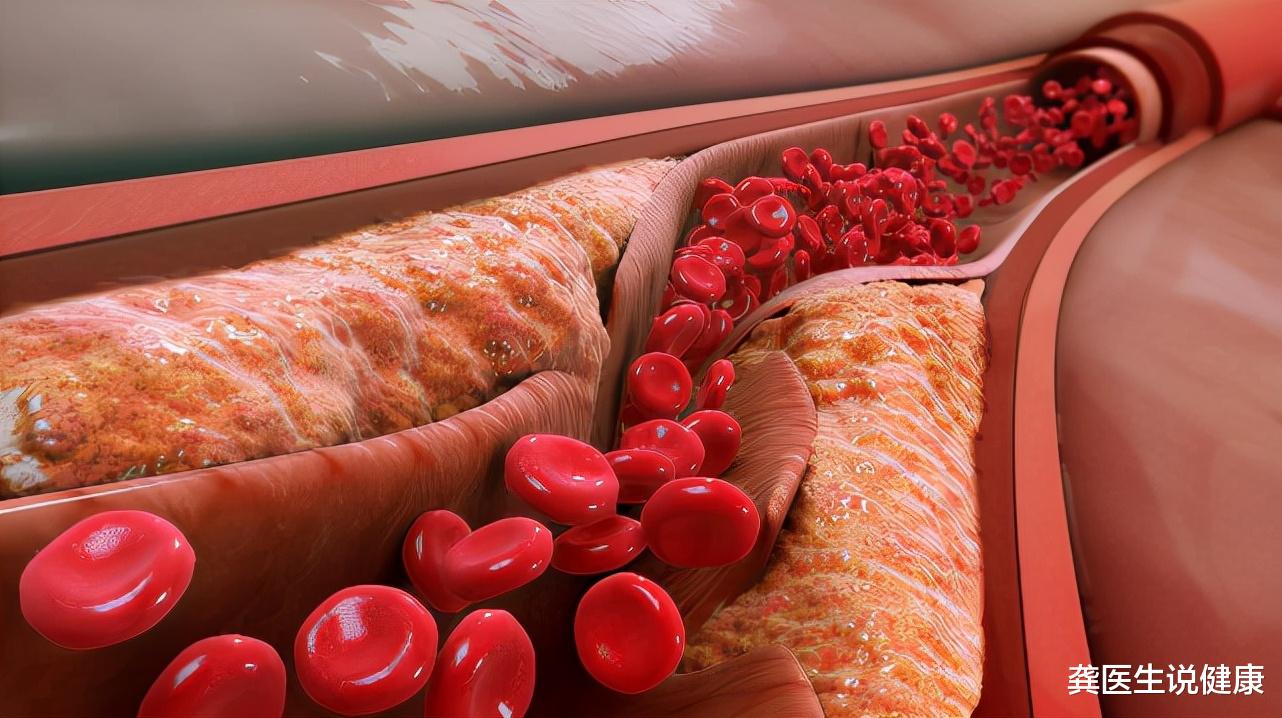 高血脂|60岁大爷爱吃“1物”,血管越“洗”越干净,高血脂或也绕道走