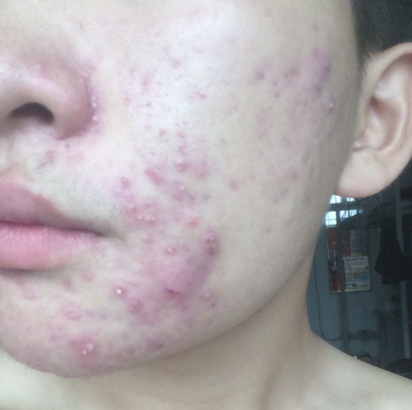 痤疮|长痤疮是体内毒素太多？医生毫不掩饰：摆脱这4个因素