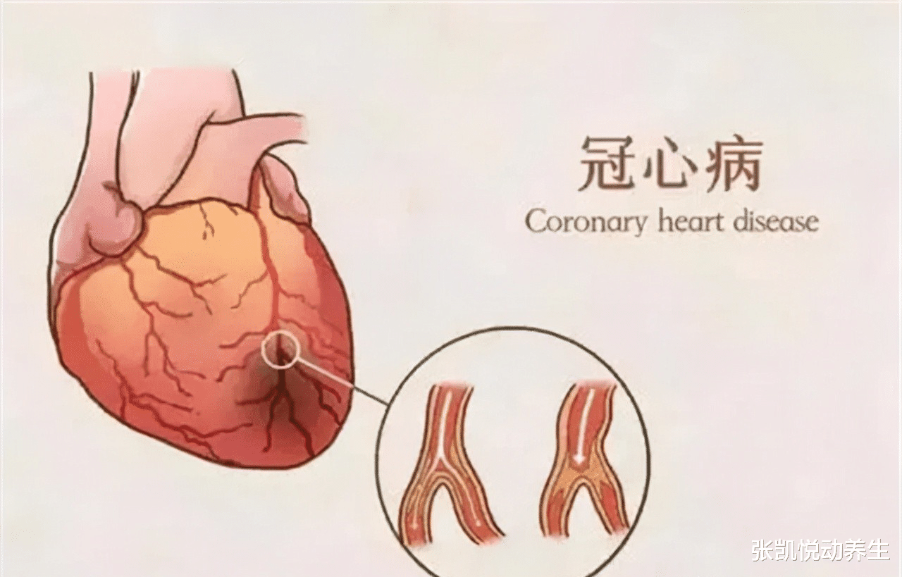 张凯悦动养生|冠心病患者服用这3种药物，能有效预防心梗、改善预后