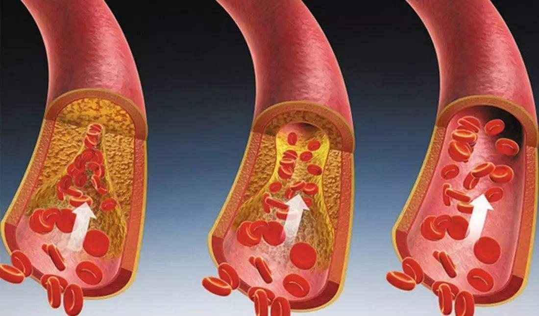胆固醇|胆固醇“分解器”或被找到?并非白醋,常喝点,有助保护血管