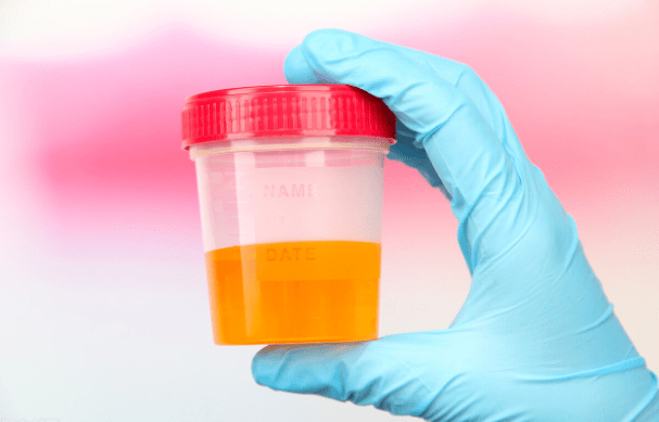 肾病之友 尿蛋白从3.47克降到0.5克以下,她是如何恢复正常的?