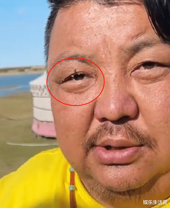 徐晓峰|网曝恩克恐步泡泡龙后尘，不听劝告只为钱，脸上长满脂肪粒还在吃