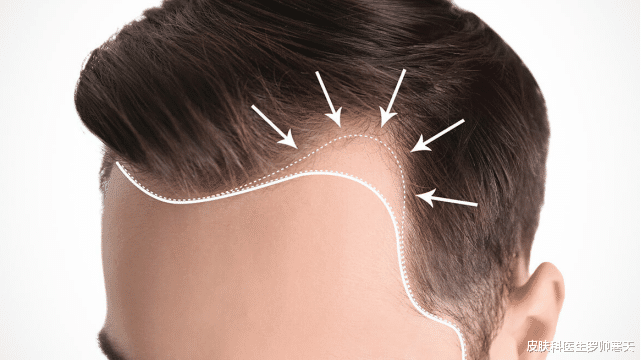 肾病|脱发能够恢复吗?8种常见性脱发,快收藏