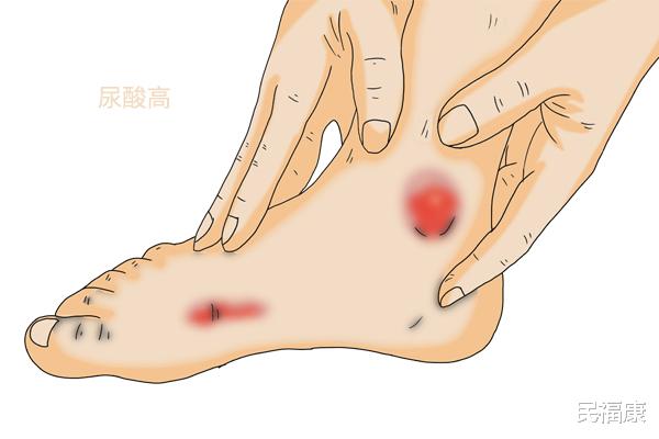 尿酸|患有高尿酸,是“吃”惹的祸?想要有效控制,记好“4少3多”