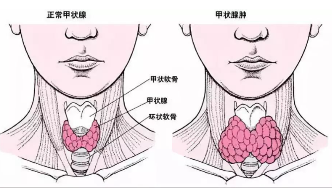 金兰中医学社 “散结高手”被发现，不是大蒜，每天吃，排出甲状腺毒素，肿瘤慢慢消失