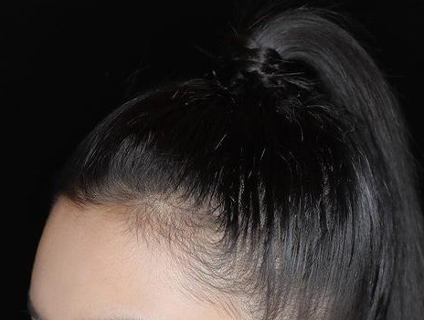 清克颜究所 古芳栢草：年纪轻轻就发际线后移，与哪些因素有关？