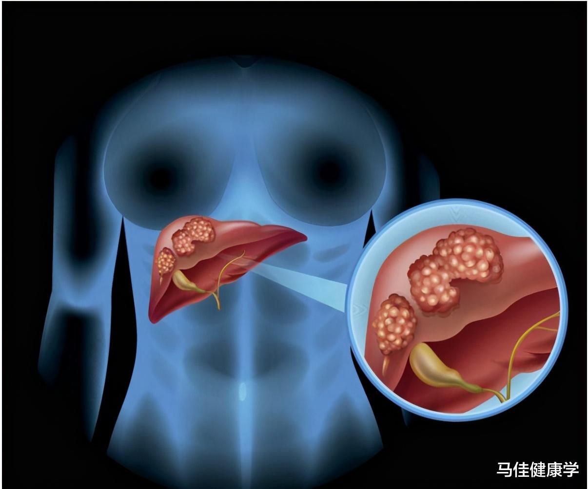 血糖|男子肩疼一年,坚持3个月离世,专家:这病,每年夺去30万人生命