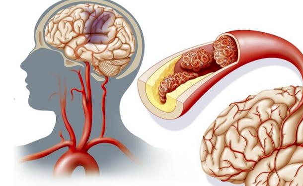 小米粥|神经内科专家：脑梗来临，身体2个月前会有“暗示”吗？了解一下
