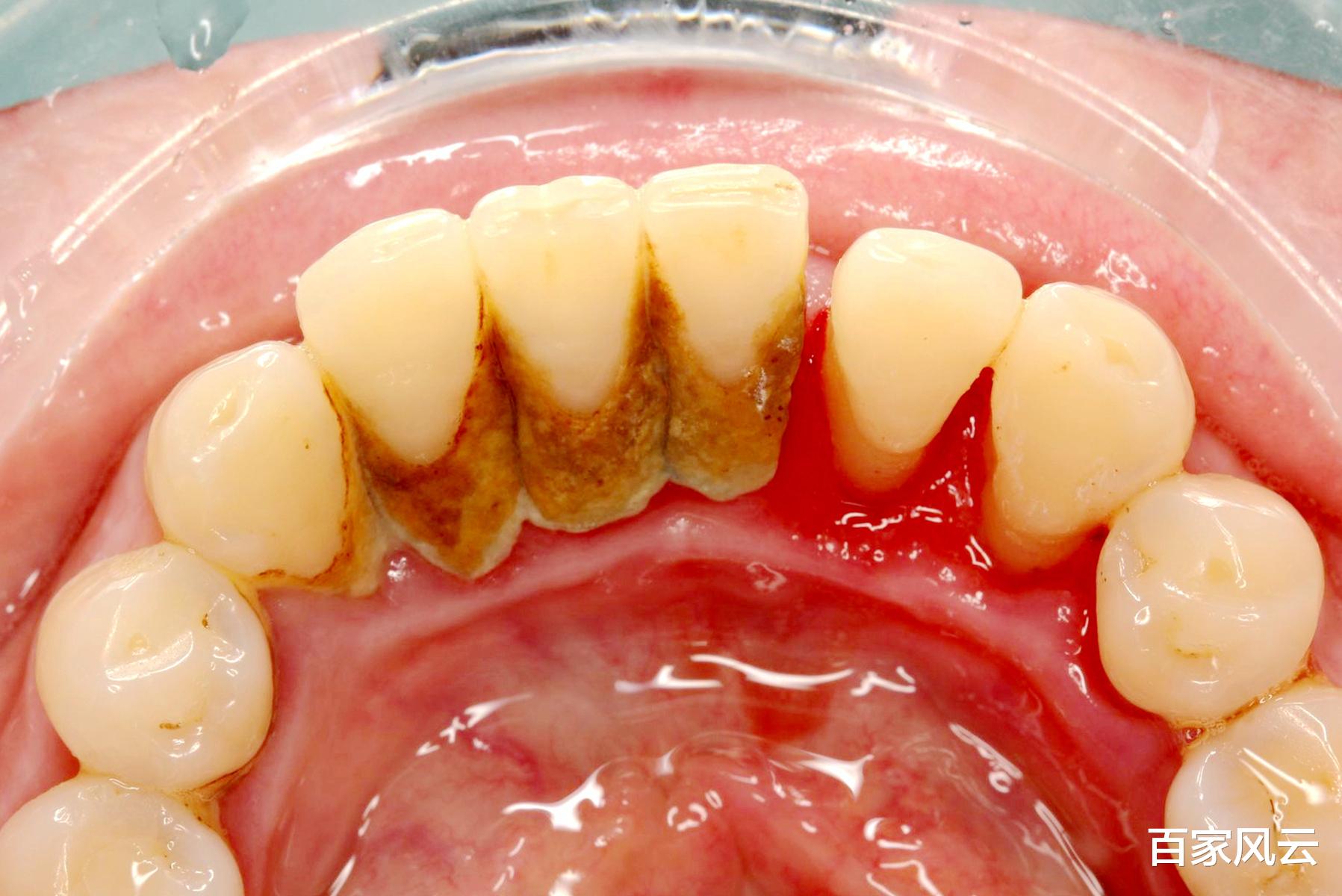 时尚好物官 牙缝里的“黄牙垢”别用手抠，牙医：教一小妙招，让“脏牙垢”自己掉