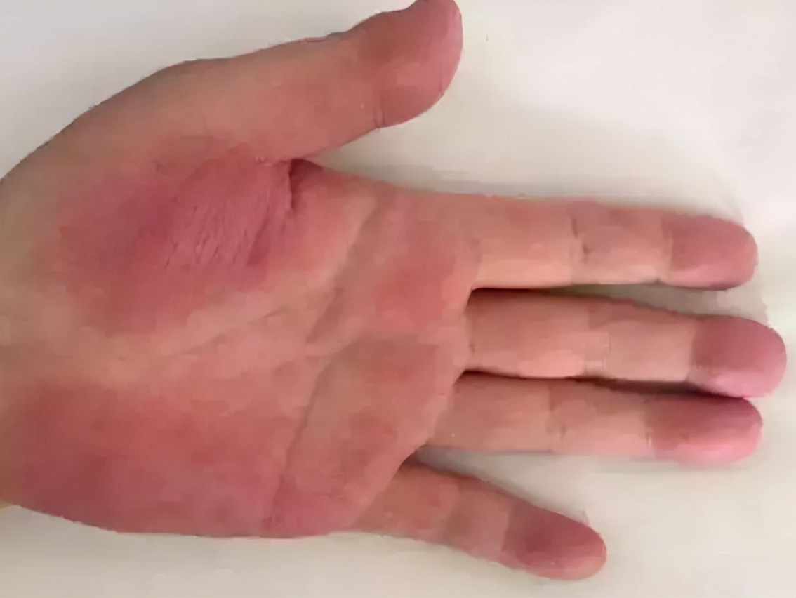 肝脏|肝硬化的“根源”被揪出,医生提醒:不想肝“报废”,这4物白给也不要