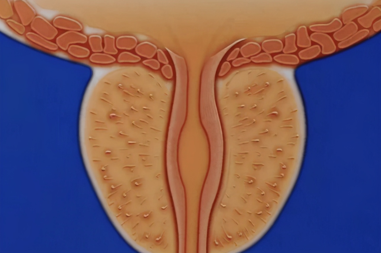 前列腺炎|晨起3个“迹象”，可能是前列腺炎的信号，拖久了腺体将“烂如筛子”