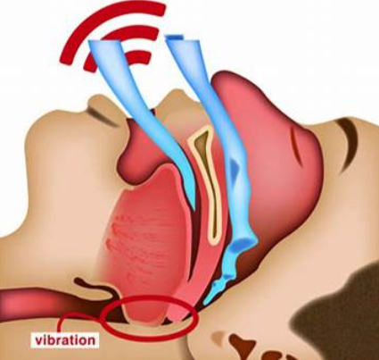 排便|打呼噜，是病吗？医生建议买个呼吸机，是不是小题大做了？