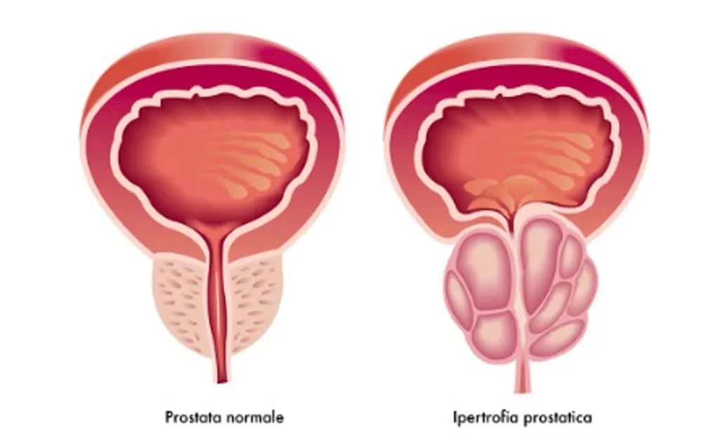 前列腺|老年人排尿困难怎么办？这些“罪魁祸首”得一一处理了
