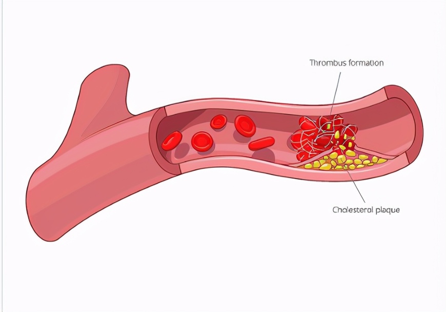 血栓|血栓就怕\1酸\，并非老陈醋，你若爱吃，降脂溶栓，脑梗\避而远之\