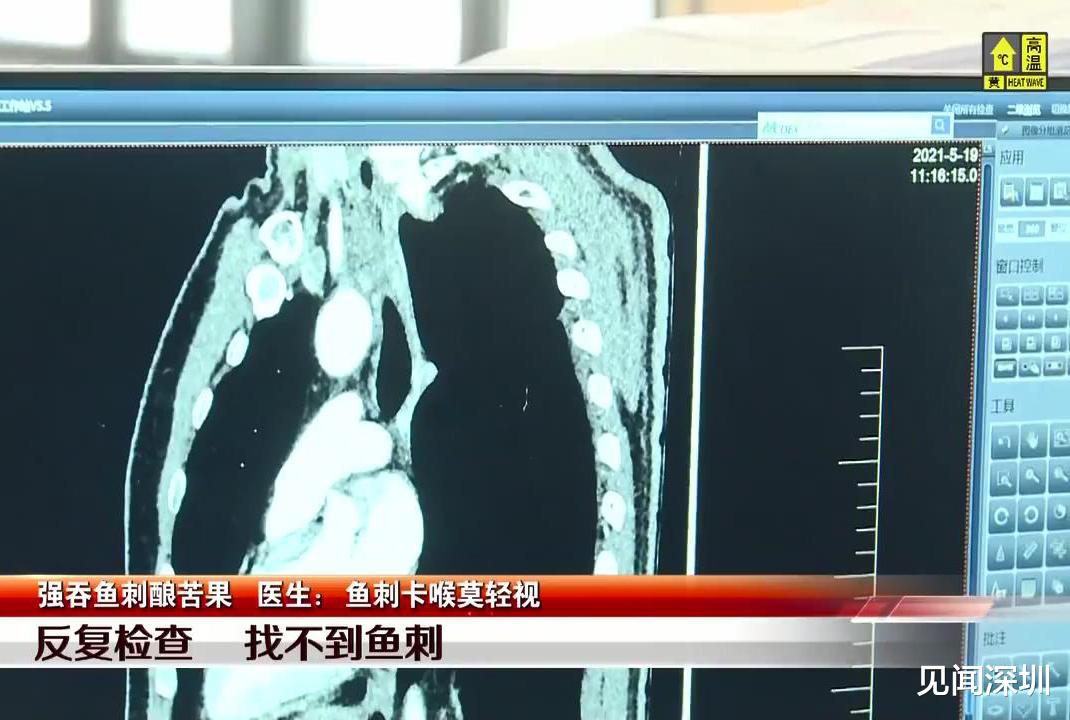 见闻深圳 教训啊!深圳男子硬吞鱼刺致食管破裂危及生命,多次CT检查无果