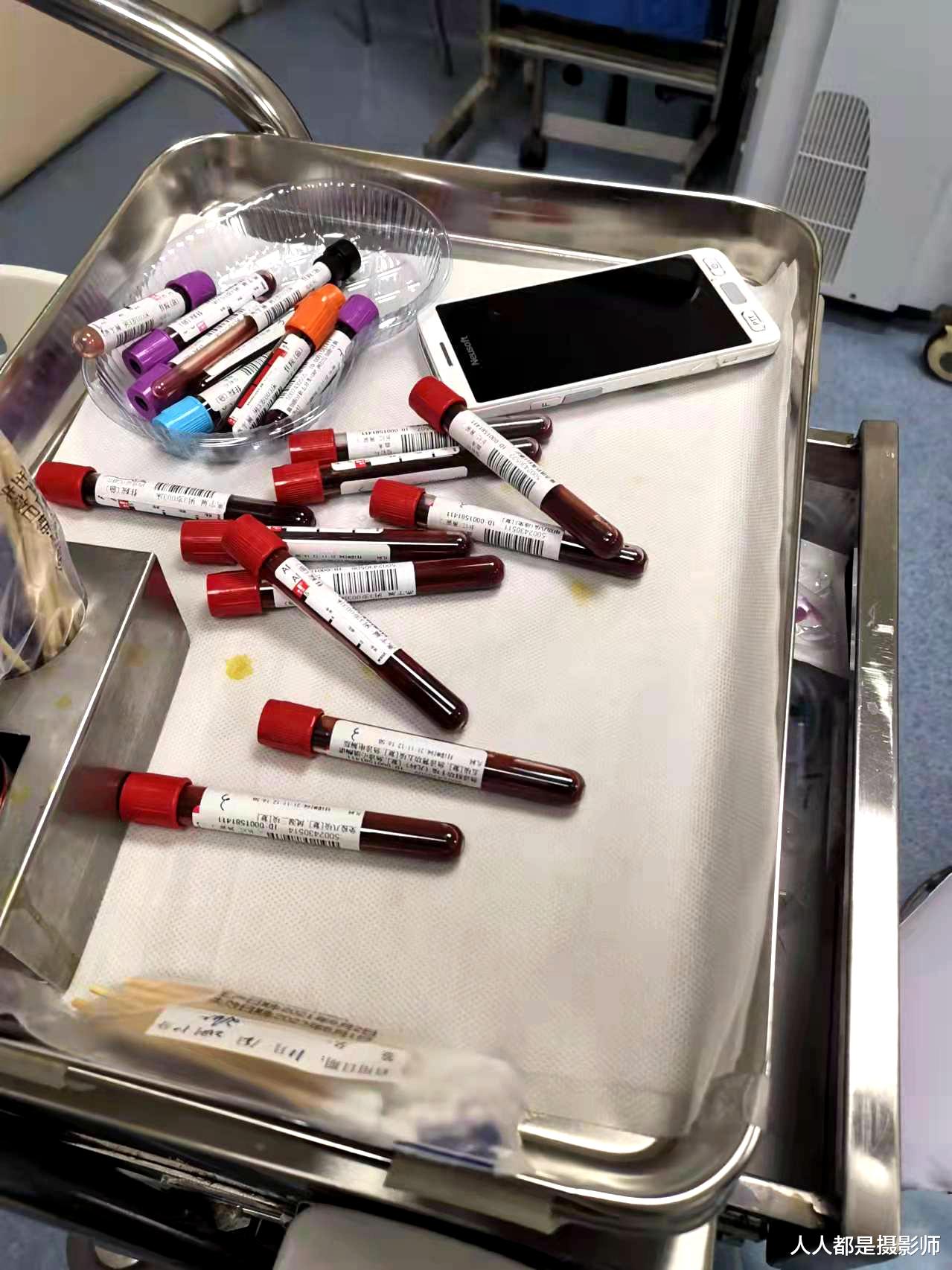 肾病|男孩高烧查出重病，2年做17次腰穿又复发，爸爸摔倒也查出肾病