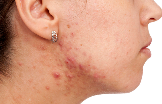 高血压|26岁女孩频繁乏力，确诊肝癌，医生痛斥：年轻不知克制，肝脏不烂才怪