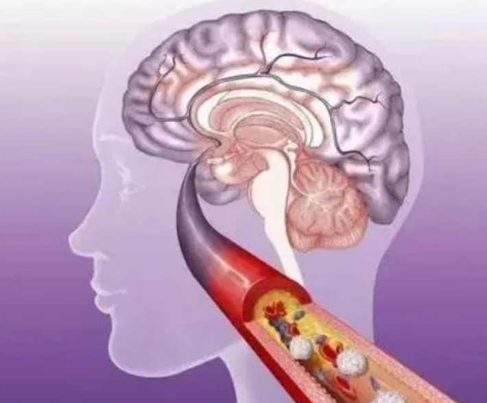 运动|医生提醒：3大运动可以降低脑梗死亡率，快转给家人看一看