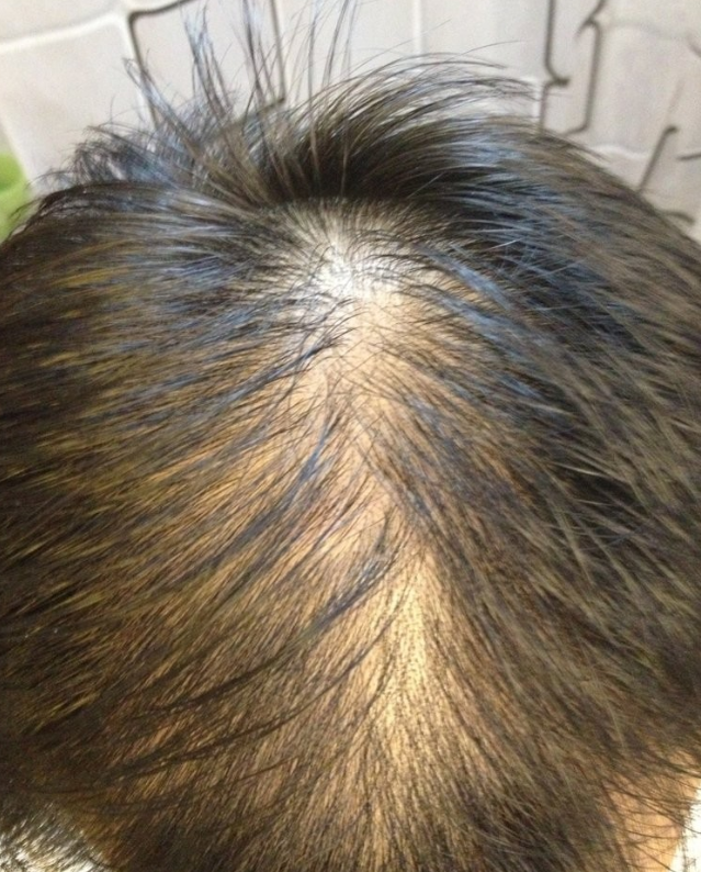 楚门妙手|男人白发、斑秃、地中海、溢脂性脱发— —临床常用中成药（新）