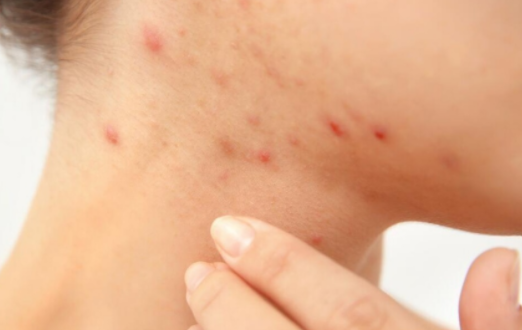 医生|身体上这2个地方的“红点”能不能抠?医生回答:不能,这可能是HPV