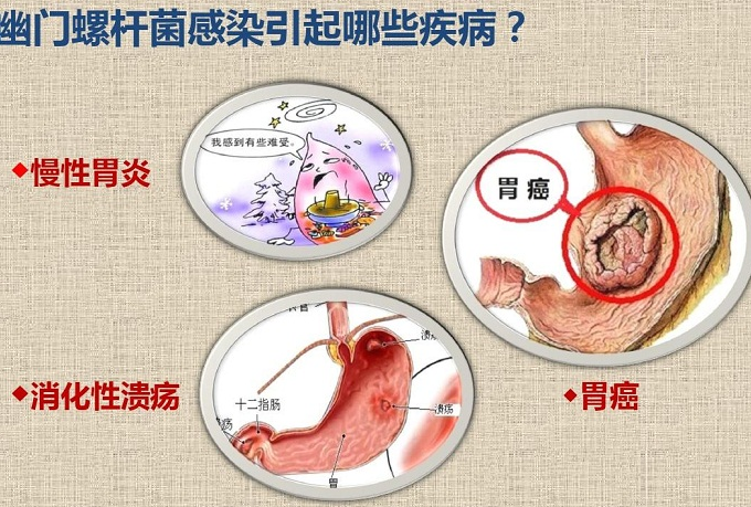 医线天|萝卜是胃病的发物？医生：除了萝卜，3种食物也要少食，胃才更强韧