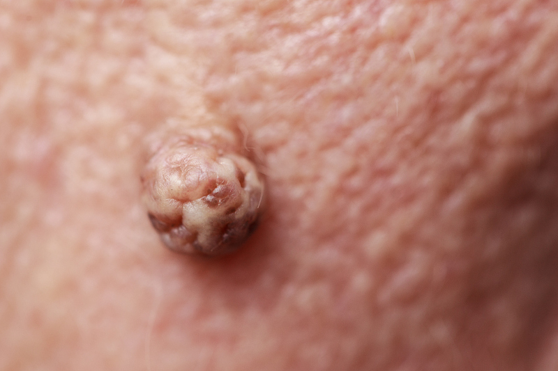 |无论男女，身上一处“瘙痒无比”，可能是HPV近身，尽早了解