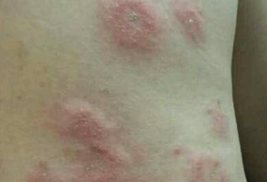 千金芳 程序员身上起“肉瘤”是感染HPV？还可能转癌？医生：是真的